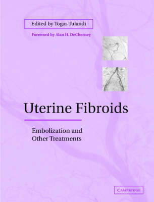 Uterine Fibroids: Embolization and other Treatments (Hardback)