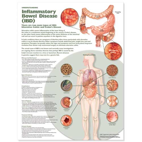 Understanding Inflammatory Bowel Disease (IBD) Anatomical Chart (Wallchart)