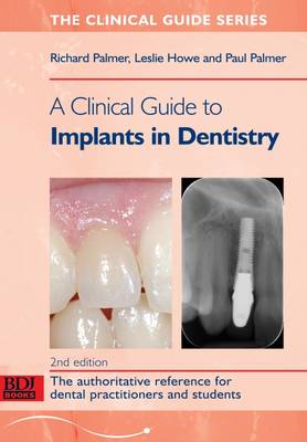 A Clinical Guide to Implants in Dentistry (Paperback)