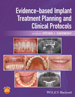 Evidence-based Implant Treatment Planning and Clinical Protocols (Hardback)