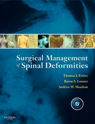 Surgical Management of Spinal Deformities (Hardback)