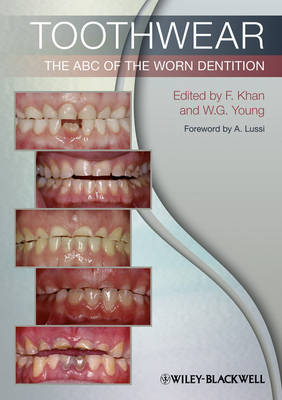 Toothwear: The ABC of the Worn Dentition (Paperback)