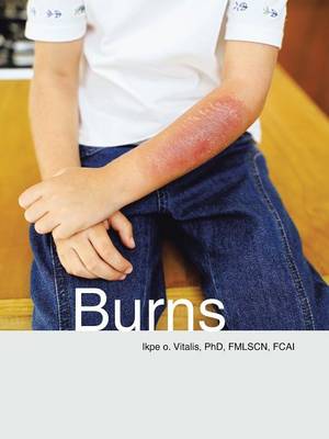 Burns (Paperback)