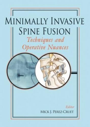 Minimally Invasive Spine Fusion: Techniques and Operative Nuances (Hardback)