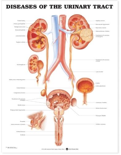 Diseases of the Urinary Tract Anatomical Chart (Wallchart)