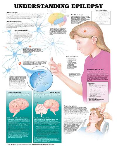 Understanding Epilepsy Anatomical Chart (Wallchart)