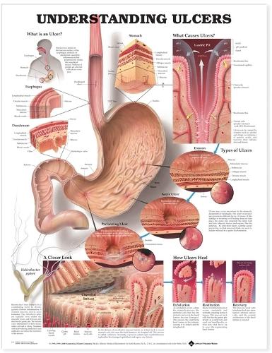 Understanding Ulcers Anatomical Chart (Wallchart)