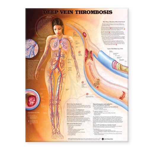 Deep Vein Thrombosis Anatomical Chart (Wallchart)