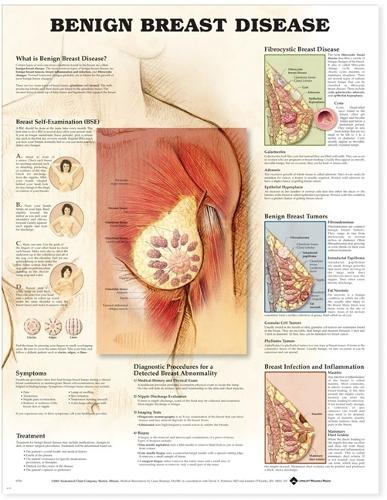 Benign Breast Disease Anatomical Chart (Wallchart)