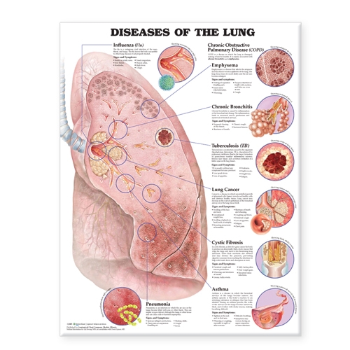 Diseases of the Lung Anatomical Chart (Wallchart)