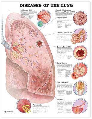 Diseases of the Lung (Wallchart)