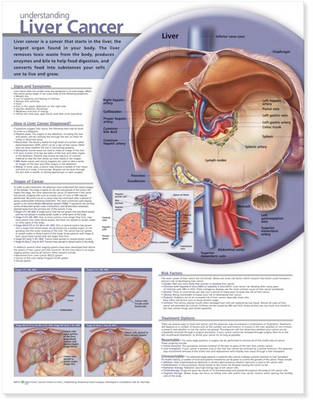 Understanding Liver Cancer Anatomical Chart (Wallchart)