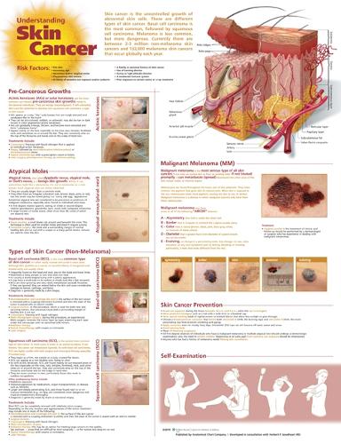 Understanding Skin Cancer Anatomical Chart (Wallchart)