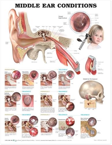 Middle Ear Conditions Anatomical Chart (Wallchart)