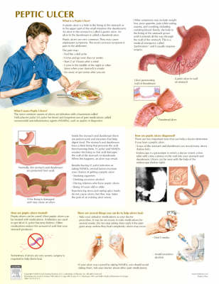 Peptic Ulcer Chart - Netter Charts (Poster)