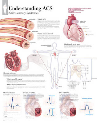 Understanding ACS (Acute Coronary Syndrome) Laminated Poster (Poster)