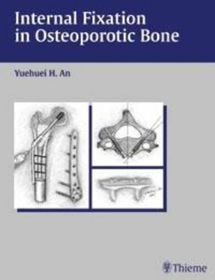 Internal Fixation in Osteoporotic Bone (Hardback)