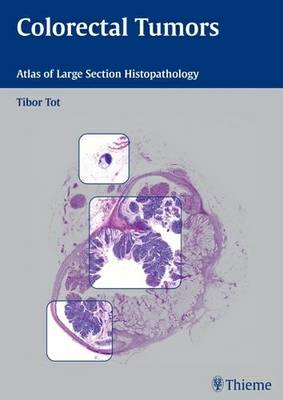 Colorectal Tumors (Hardback)