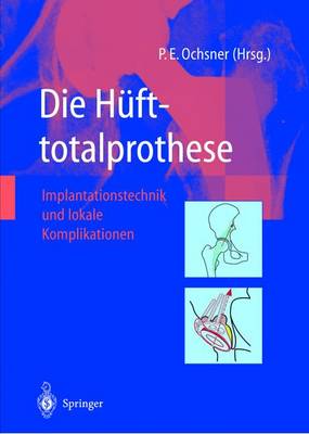 Die Hufttotalprothese: Implantationstechnik Und Lokale Komplikationen (Hardback)