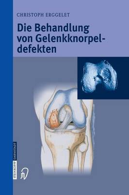 Die Behandlung Von Gelenkknorpeldefekten (Paperback)