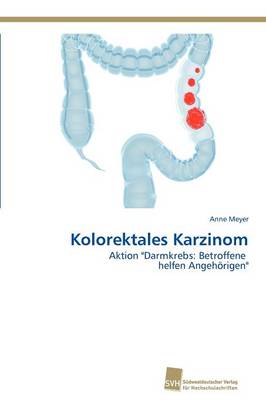 Kolorektales Karzinom (Paperback)