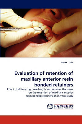 Evaluation of Retention of Maxillary Anterior Resin Bonded Retainers (Paperback)