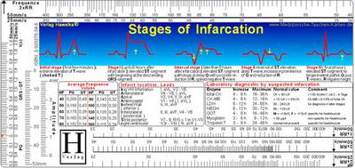 ECG Ruler - Heart Attack