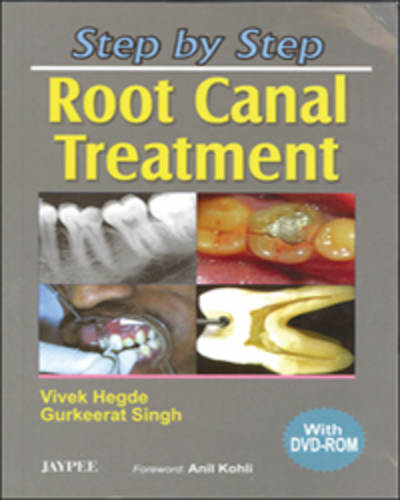 Step by Step: Root Canal Treatment - Step by Step
