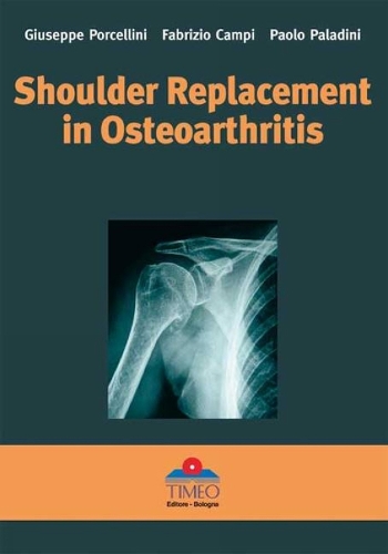 Shoulder Replacement in Osteoarthritis (Hardback)