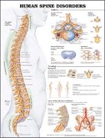 Human Spine Disorders Anatomical Chart (Wallchart)